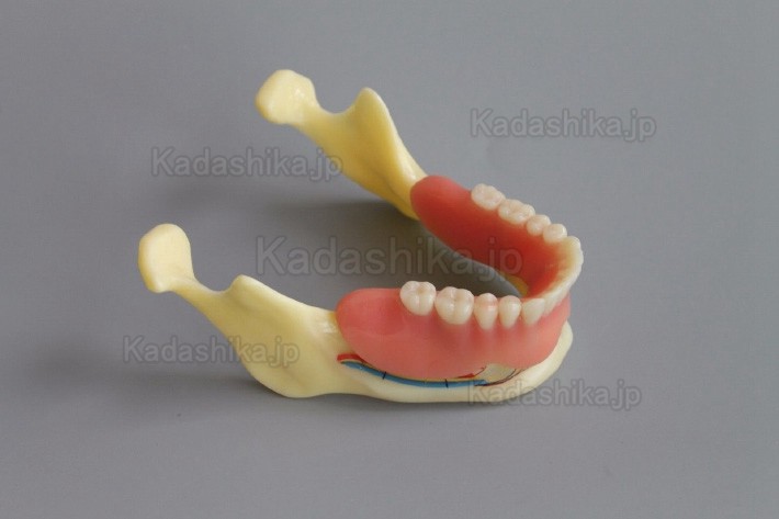 下顎骨組織とインプラント模型 + オーバーデンチャーモデル ＃2014 02